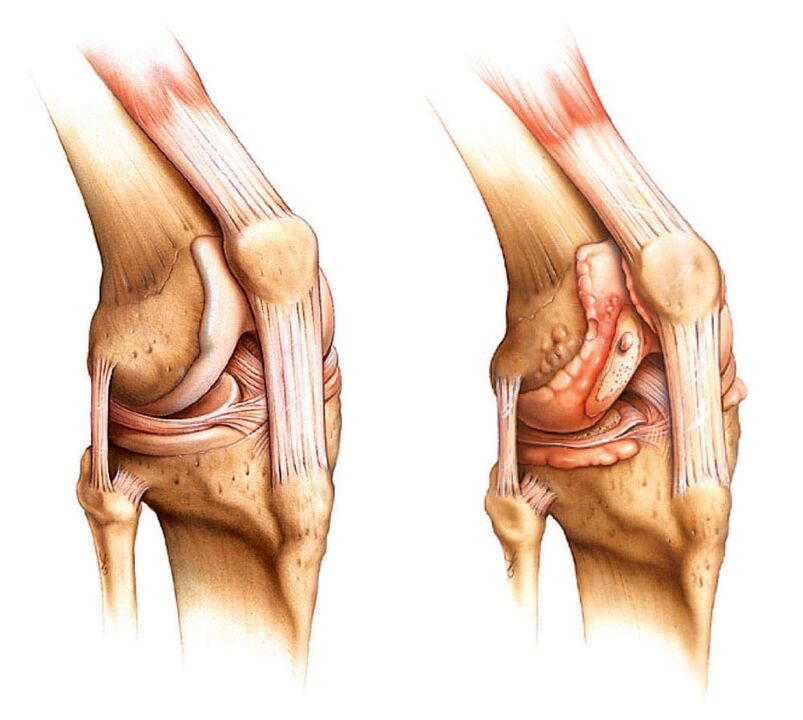 Terve liiges (vasakul) ja artriitiline liiges (paremal)