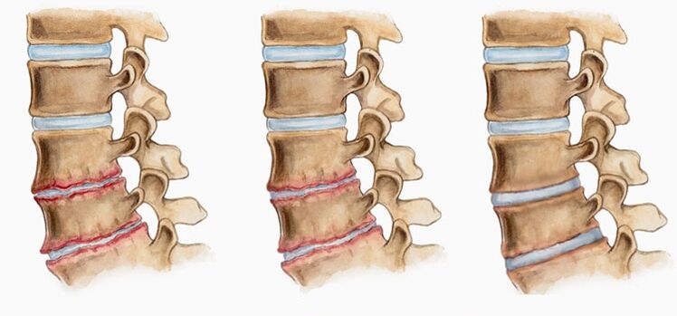 Osteokondroosi intervertebraalsete ketaste deformatsioon võib põhjustada seljavalu