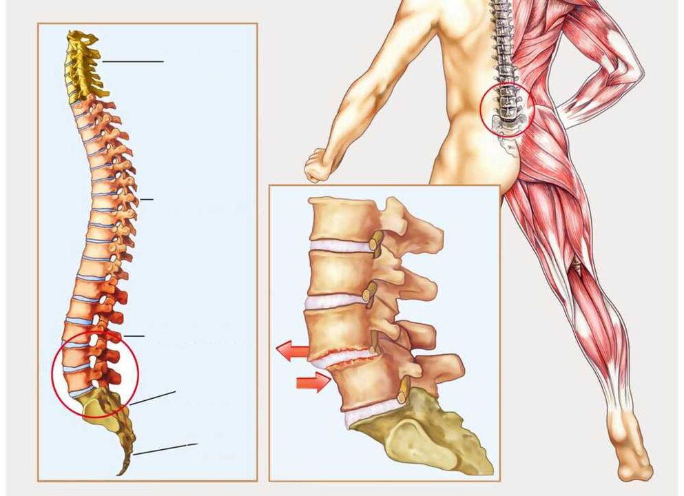 terve ja haige selgroog